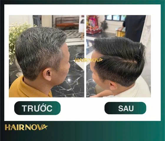 Kết quả trị liệu da đầu gàu nấm