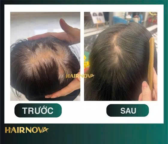 Phục hồi cấu trúc nang tóc
