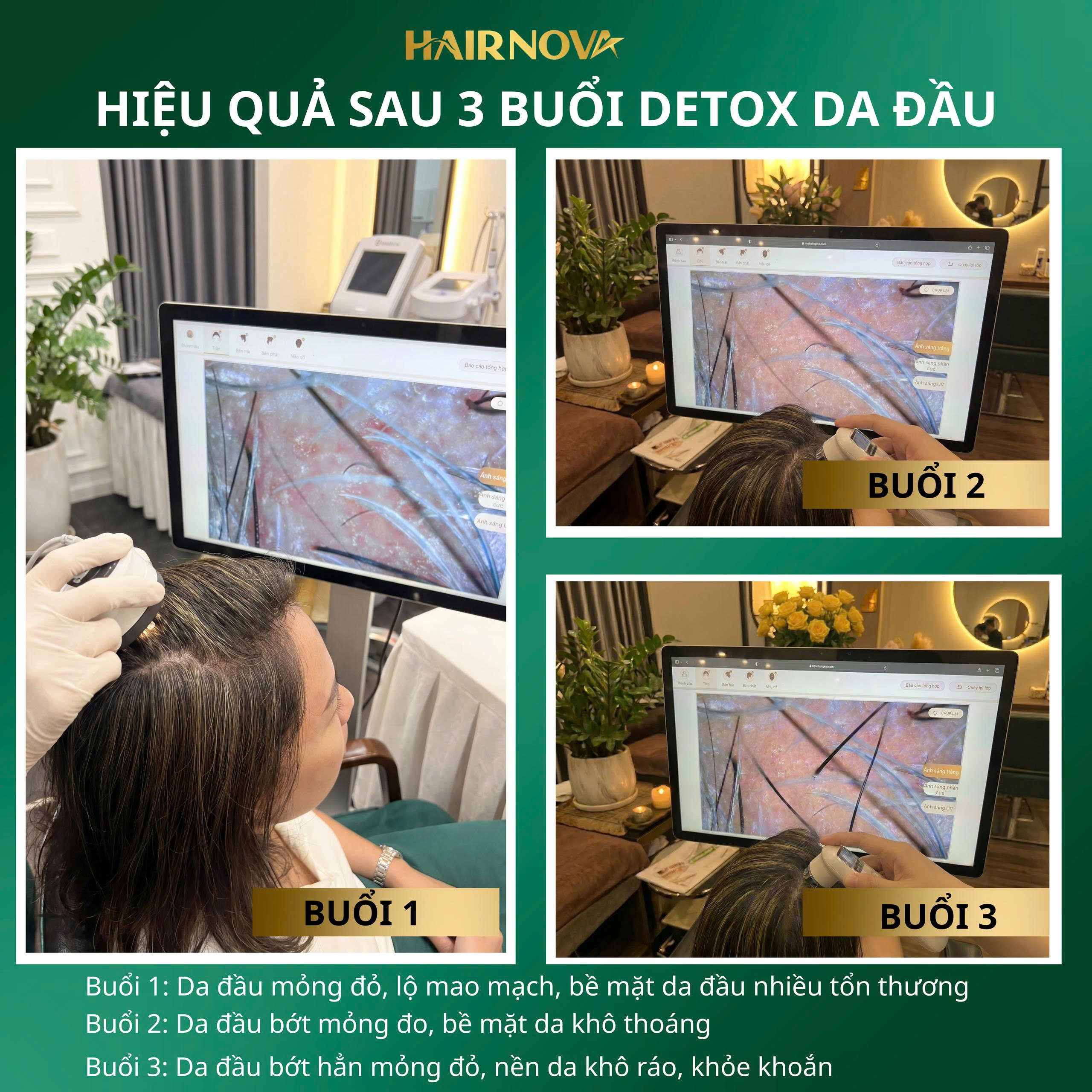 Kết quả nuôi dưỡng phục hồi nền da đầu